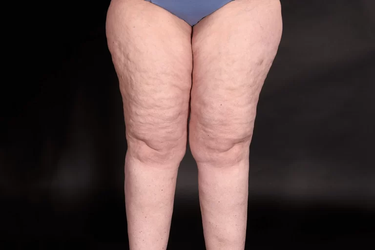 Celebrities With Lipedema: Advocates for Awareness and Acceptance