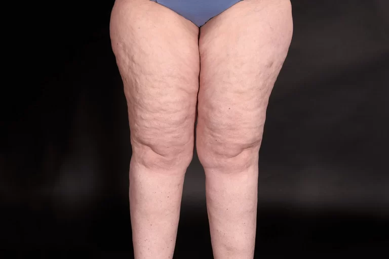 Lipedema